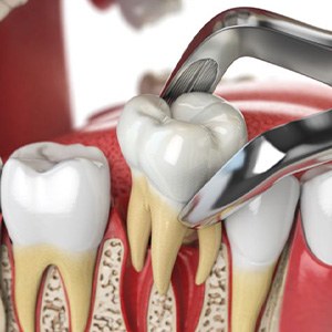 Illustration of dental forceps performing a tooth extraction