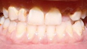 dental crowns before
