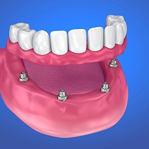 digital model of an implant-supported denture