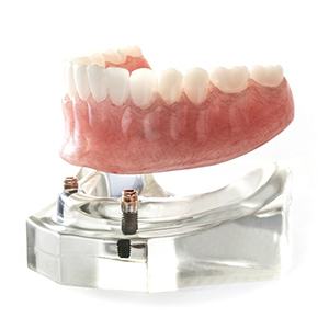 plastic model of denture and dental implants