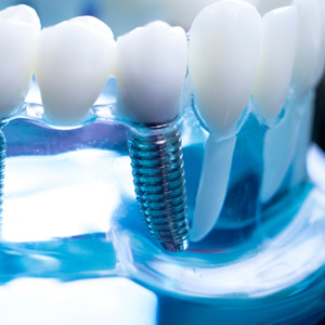 Close up of a model of the mouth with two dental implants replacing two teeth