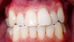 teeth before invisalign