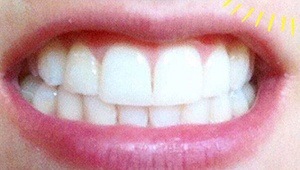 after teeth whitening
