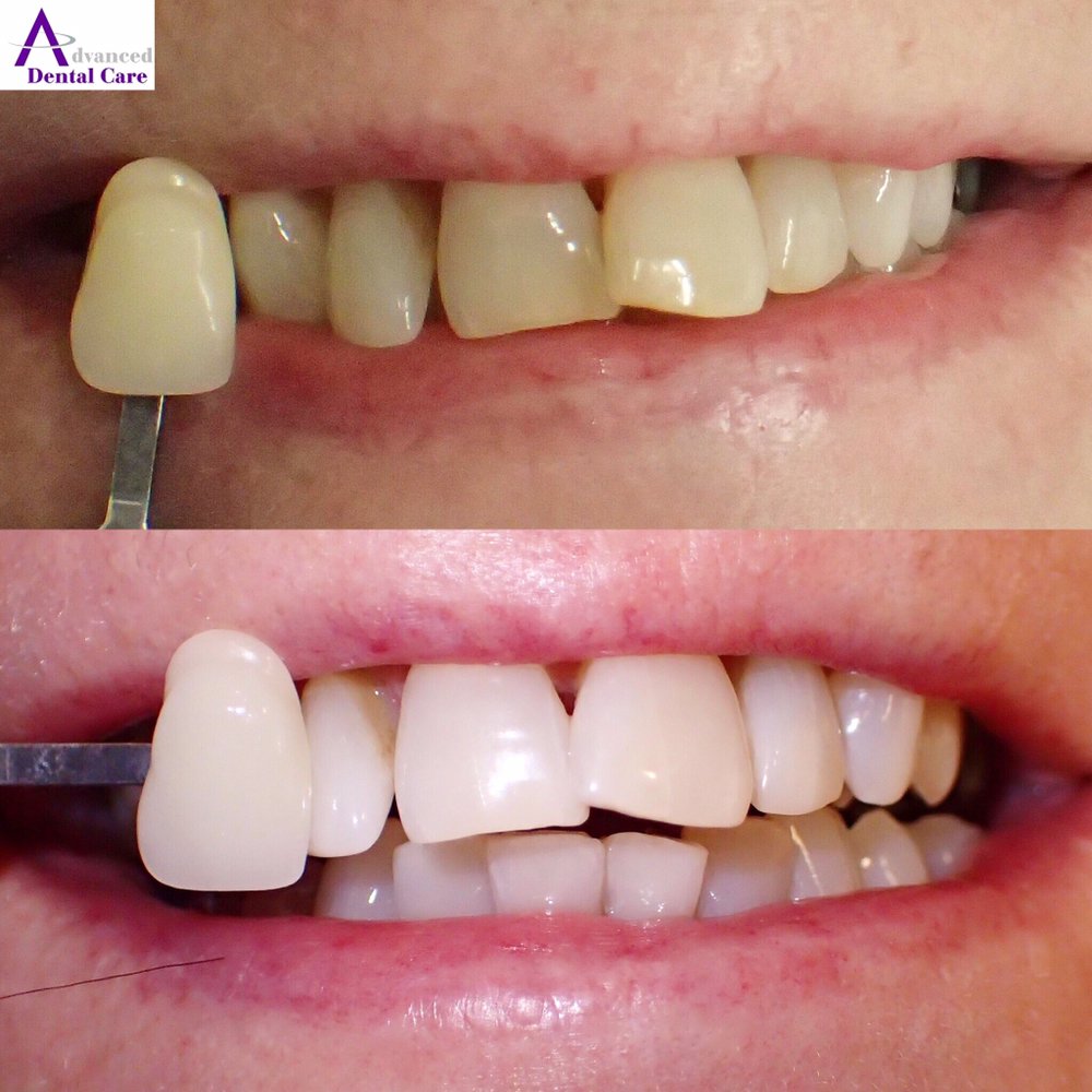 Teeth whitening laser bristol