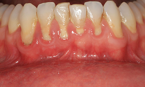 Periodontal Disease Boneloss 